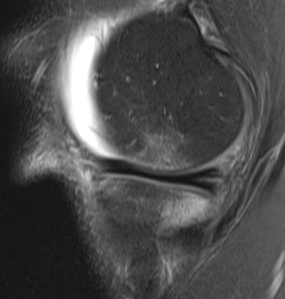MRI ACL Rupture Bone Oedema Terminal Sulcus